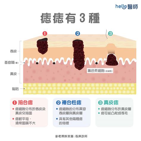 長毛的痣|痣上長毛有問題嗎？哪些痣會變成癌？千萬別忽視這6種情況